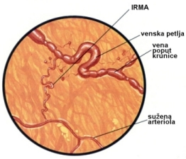 5Vaskularne promjene u DM-fundus.jpg (40487 bytes)