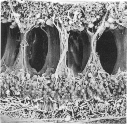 Cistoidni_makularni_edem_EM.jpg (53676 bytes)