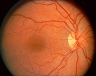 Normalni fundus.jpg (57842 bytes)